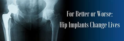 Personal Injury Lawsuits: Hip Implants