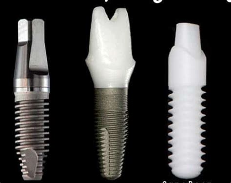 Zirconia Dental Implants Pros and Cons Video | Ramsey A. Amin, DDS