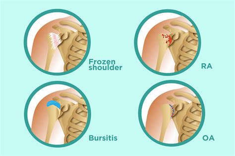 Rheumatoid Arthritis of the Shoulder | USA Spine Care & Orthopedics