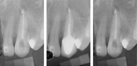 Radiographs of an upper canine. The postoperative radiograph (a) and ...