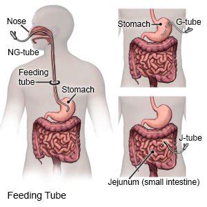 Tube Feeding - What You Need to Know