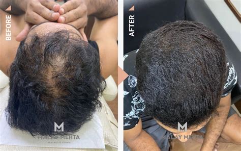 Alopecia Treatment - Dr Malay Mehta