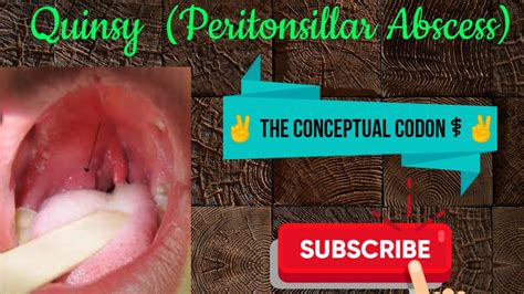 Peritonsillar Abscess Identification And Treatment – Otosection