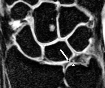 Triangular Fibrocartilage Tear | Radsource