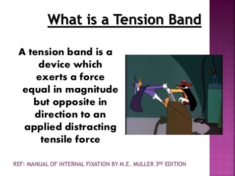 Principle of tension band wiring n its application