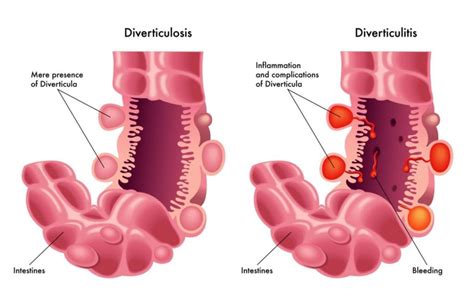 Gastroenterologists In Florida | Diverticular Disease - Gastroenterologists In Florida