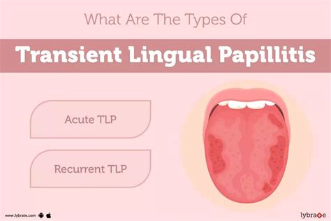 Transient Lingual Papillitis: Causes, Symptoms, Treatment and Cost