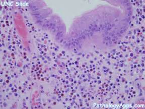 inflammatory polyp pathology