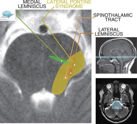 Lateral Pontine Syndrome Mri