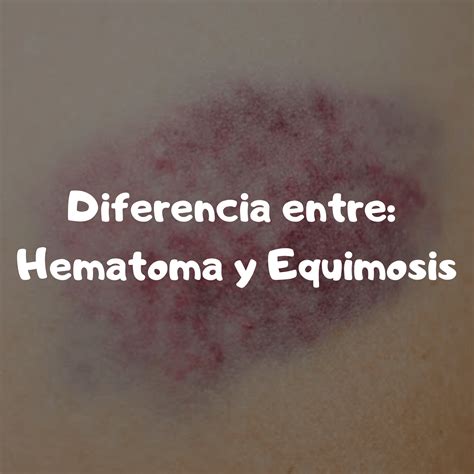 Hematoma y equimosis diferencia