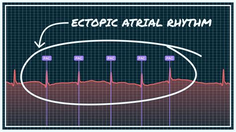 What Ectopic Atrial Rhythm Looks Like on Your Watch ECG | Qaly