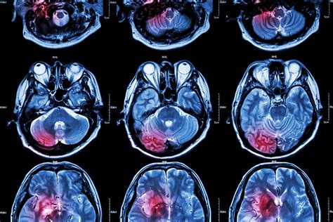 The Differences Between Imaging Studies Used to Diagnose Brain Injuries - Elizabeth Sandel, M.D.