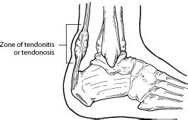 Kager's Fat Pad Inflammation - Ankle, Foot and Orthotic Centre