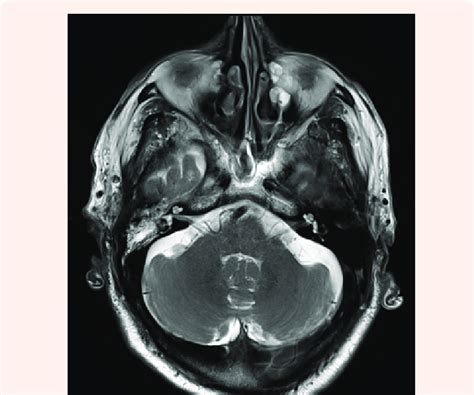 a: Axial slice of T2, diffusion-weighted MRI showing soft tissue and ...