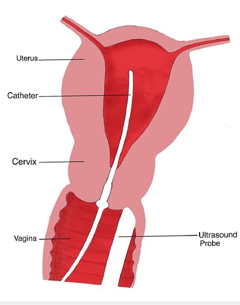 Imaging technique in saline infusion sonohysterography. | Download Scientific Diagram