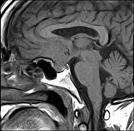 Meningioma-tuberculum sellae | Radiology Case | Radiopaedia.org