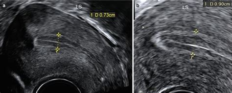 Ultrasound Evaluation of Endometrium | Obgyn Key