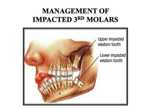 THIRD MOLAR IMPACTION (BASIC)