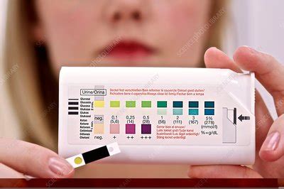 Urine diabetes test - Stock Image - C014/1231 - Science Photo Library