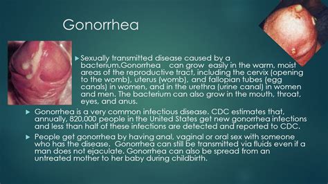 Gonorrhea symptoms pictures men - hacjourney