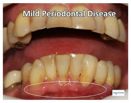 Your Ultimate Guide to Periodontal Disease - Periodontitis