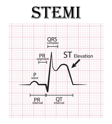 Acute Myocardial Infarction | NursingCE