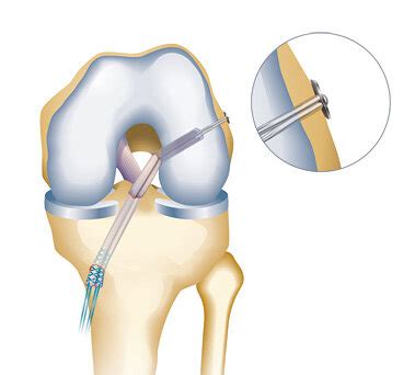 ACL reconstruction — Sports Orthopaedic Centre