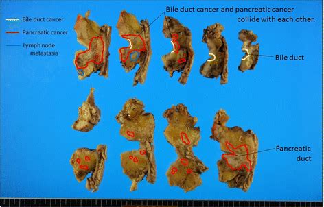 A case study of a collision tumor composed of cancers of the bile duct and pancreas | Surgical ...