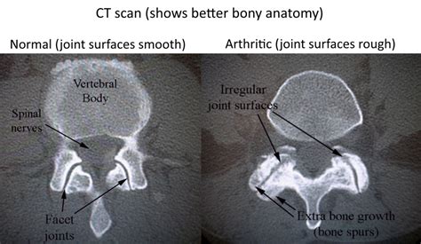 Facet Arthritis - Drwolgin