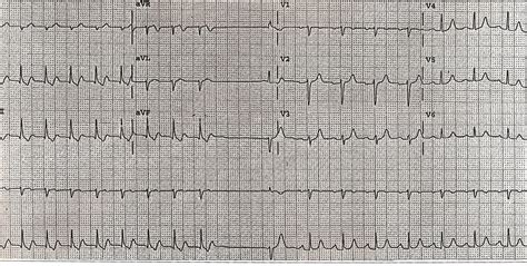 Atrioventricular Nodal Reentrant Tachycardia – Core EM