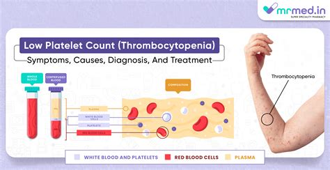 Low Platelet Count (Thrombocytopenia): Symptoms, Causes, Diagnosis, and Treatment | MrMed