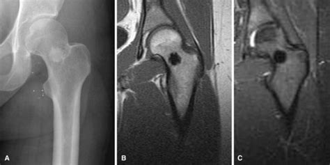 Benign Bone Tumors and Nonneoplastic Conditions Simulating Bone Tumors | Musculoskeletal Key