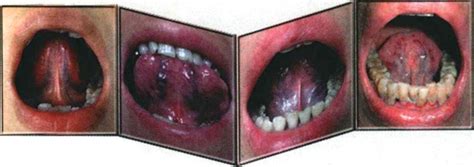 Sublingual veins in TCM tongue diagnosis