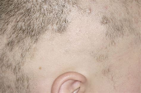 Alopecia areata | BabyCenter