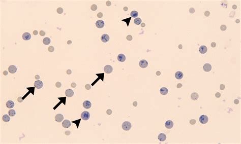 Reticulocytes – Cells and Smears