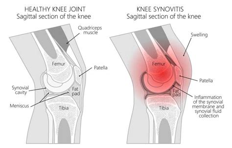 Knee Joint Swelling Causes and Solutions | BioSkin Bracing Solutions