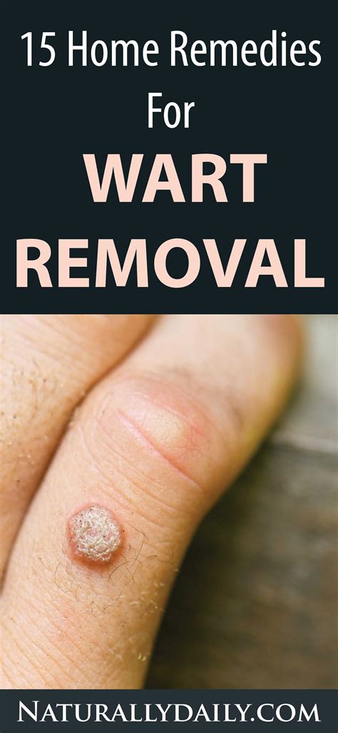 15 Home Remedies for Warts – Easy Home Wart Treatments - thepinspopular09.blogspot.com