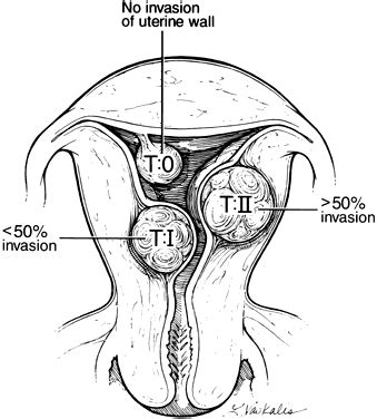 Role of Sonography and Hysterosonography In Operative Endoscopy | GLOWM