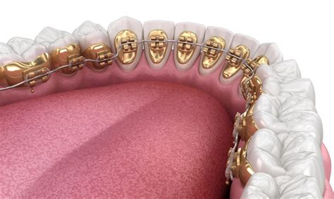 Dental Braces in Turkey: Cost, Types, and Treatment