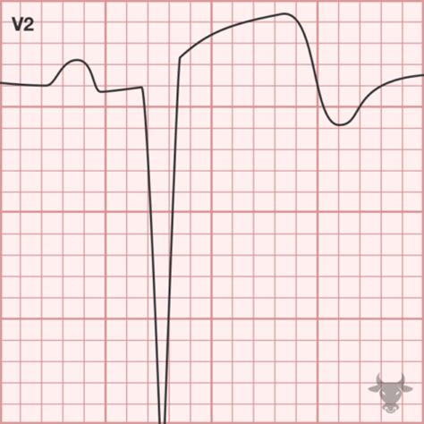 Left Ventricular Aneurysm | ECG Stampede