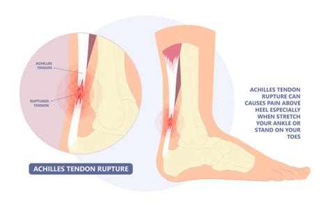 Achilles Tendon Rupture - Gejala, Penyebab, dan Pengobatan - Alodokter