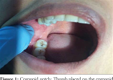 Long Buccal Nerve Block