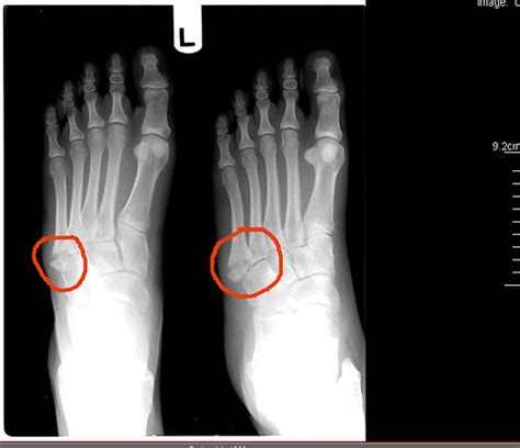 Lots of craziness: My Jones Fracture: A week later