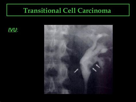 Transitional cell carcinoma