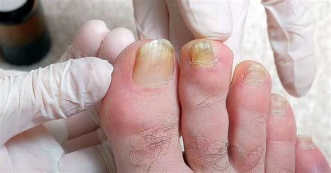 Why are my toenails yellow: Causes and treatment