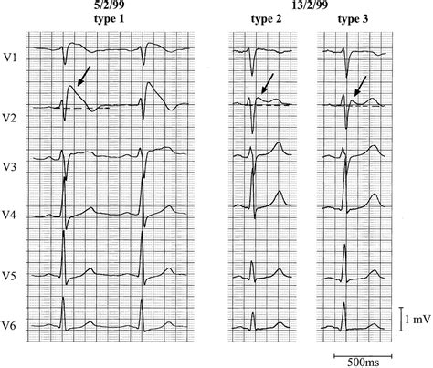 Proposed Diagnostic Criteria for the Brugada Syndrome | Circulation