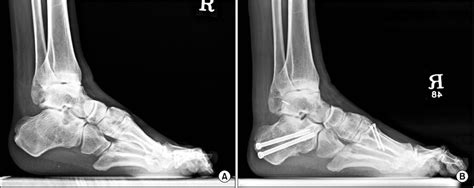 (A) The standing lateral radiograph of right foot showed a severe... | Download Scientific Diagram