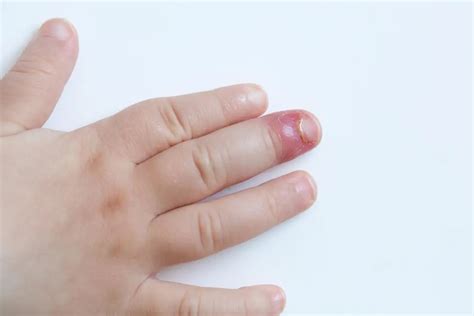 Paronychia: Causes and treatment of an infected nail