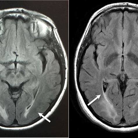 Brain MRI. Arrows indicate Bilateral symmetrical occipital ...