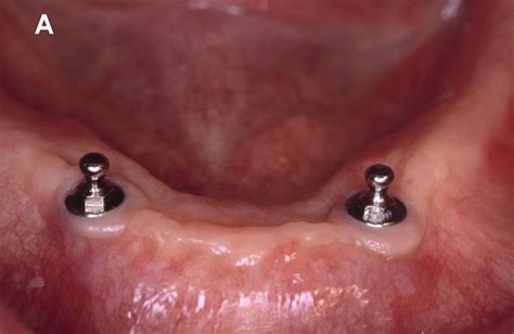 LOWER IMPLANT DENTURE- DESIGN 2